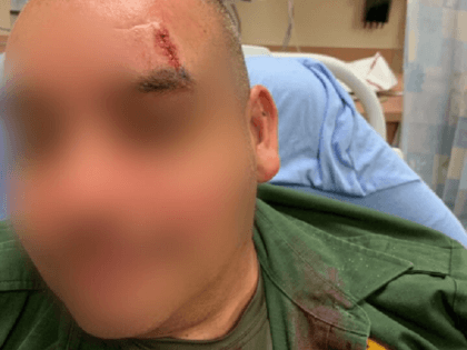An El Centro Sector Border Patrol agent received treatment for a head laceration following being struck by a large rock thrown through a damaged border barrier. (Photo: U.S. Border Patrol/El Centro Sector)