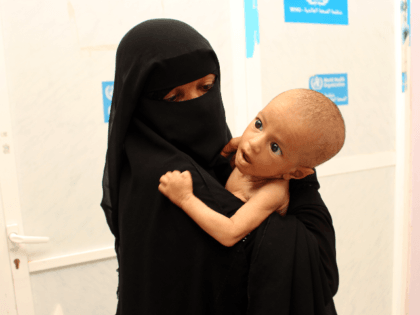 Displaced Yemeni seven-month-old baby Mohammed Hussein suffering from malnutrition is brou