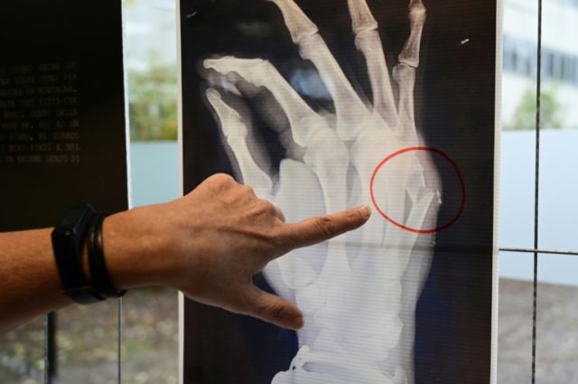 X-rays of broken bones lay bare domestic violence in Italy