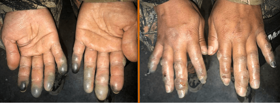 Migrant woman's hands suffer severe frostbite after being abandoned by human smugglers in Texas winter storm. (Photo: U.S. Border Patrol/Big Bend Sector)