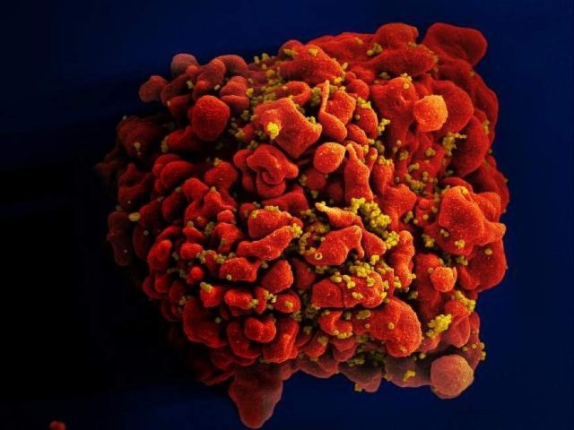 A human white blood cell infected with HIV virus -- 40 years after the first cases of what
