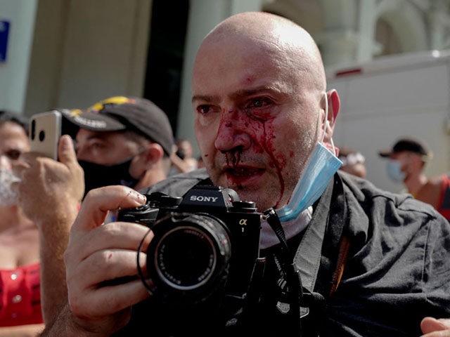 AP photographer, Spanish Ramon Espinosa, is seen with injuries in his face while covering a demonstration against Cuban President Miguel Diaz-Canel in Havana, on July 11, 2021. - Thousands of Cubans took part in rare protests Sunday against the communist government, marching through a town chanting "Down with the dictatorship" …