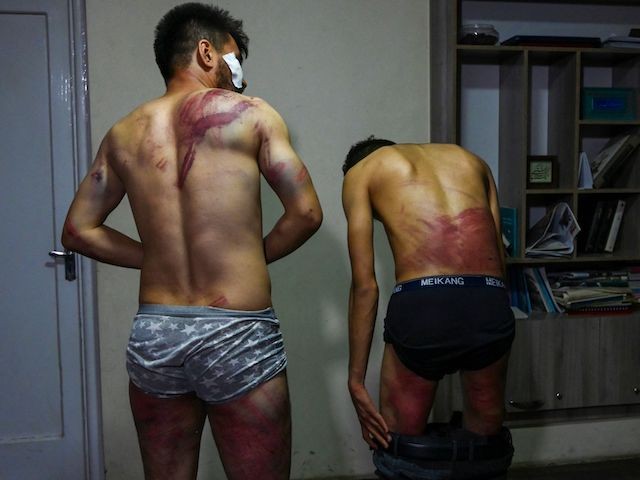 In this picture taken on September 8, 2021, Afghan newspaper Etilaat Roz journalists Nematullah  Naqdi (L) and Taqi Daryabi show their wounds in their office in Kabul after being released from Taliban custody. Two Afghan journalists have shown off ugly welts and bruises after being beaten and detained for hours by Taliban fighters for covering a protest in the Afghan capital. (Wakil Kohsar/AFP via Getty Images)