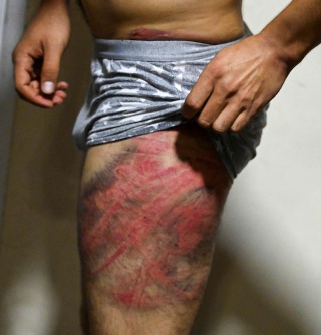 Afghan newspaper Etilaat Roz journalist Nematullah  Naqdi shows his wounds on his leg in his office in Kabul after being released from Taliban custody, September 8, 2021. (Wakil Kohsar/AFP via Getty Images)