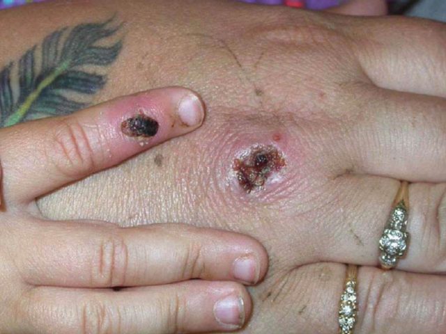 UNDATED ? JUNE 5: In this Centers for Disease Control and Prevention handout graphic, symptoms of one of the first known cases of the monkeypox virus are shown on a patient?s hand June 5, 2003. The CDC said the viral disease monkeypox, thought to be spread by prairie dogs, has …