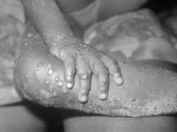 UK Health Professionals Warn There Will Be ‘Really Significant’ Rise in Monkeypox Cases