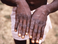 China Claims ‘Surge’ in Orders for Monkeypox Test Kits