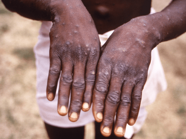 This 1997 image provided by the CDC during an investigation into an outbreak of monkeypox, which took place in the Democratic Republic of the Congo (DRC)