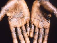 Dr. Scott Gottlieb Warns Monkeypox Could Be ‘Disruptive’ in Places Where It Spreads