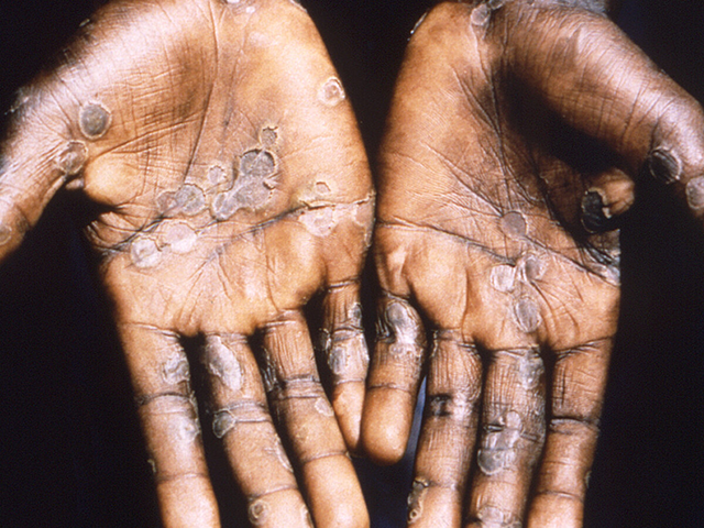 W.H.O. Says Monkeypox Poses 'Moderate' Risk to Public Health - Vimarsana News