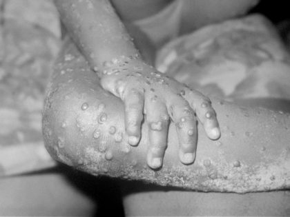 BONDUA, LIBERIA - UNDATED: In this 1971 Center For Disease Control handout photo, monkeypox-like lesions are shown on the arm and leg of a female child in Bondua, Liberia. The Centers for Disease Control and Prevention said June 7 the viral disease monkeypox, thought to be spread by prairie dogs, …