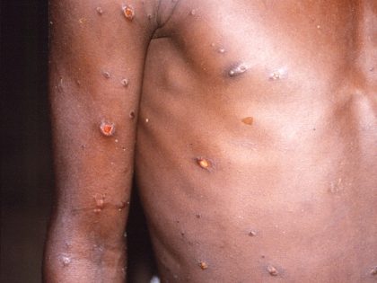 1997 Brian W.J. Mahy, BSc, MA, PhD, ScD, DSc This image was created during a investigation into an outbreak of monkeypox, which took place in the Democratic Republic of the Congo (DRC), 1996 to 1997, formerly Zaire. Pictured here, were the arms and torso, i.e., thorax and abdomen, of a …