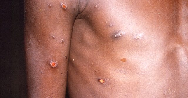 Poll: Majority Not Worried About 'Personally' Experiencing Monkeypox