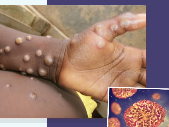 The United Nations’ Aids agency (UNAIDS) on Monday denounced some reporting on the monkeypox virus as racist and homophobic, warning irresponsible language was undermining the response outbreak as it gathers pace across the globe.