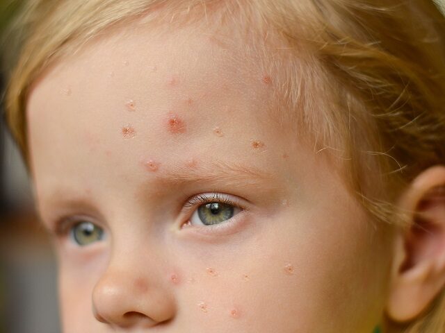 Monkeypox new disease dangerous over the world. Selective focus. Close-up of a Caucasian girl with pimples and ulcers on her face. (Stock Photo: Getty Images)