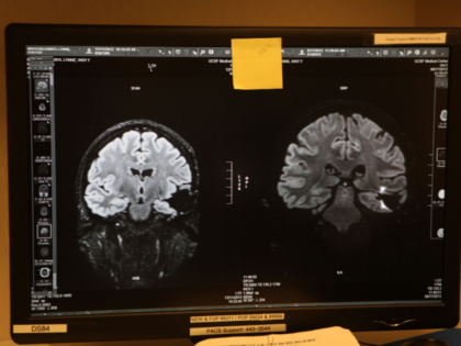 Cheryl Broyles' test results of this morning's MRI in San Francisco, California, revealed existing cancer on Tuesday, December 11, 2012. Cheryl has had over sixty MRI's and has survived 12 years of glioblastoma. (Photo By Liz Hafalia/The San Francisco Chronicle via Getty Images)