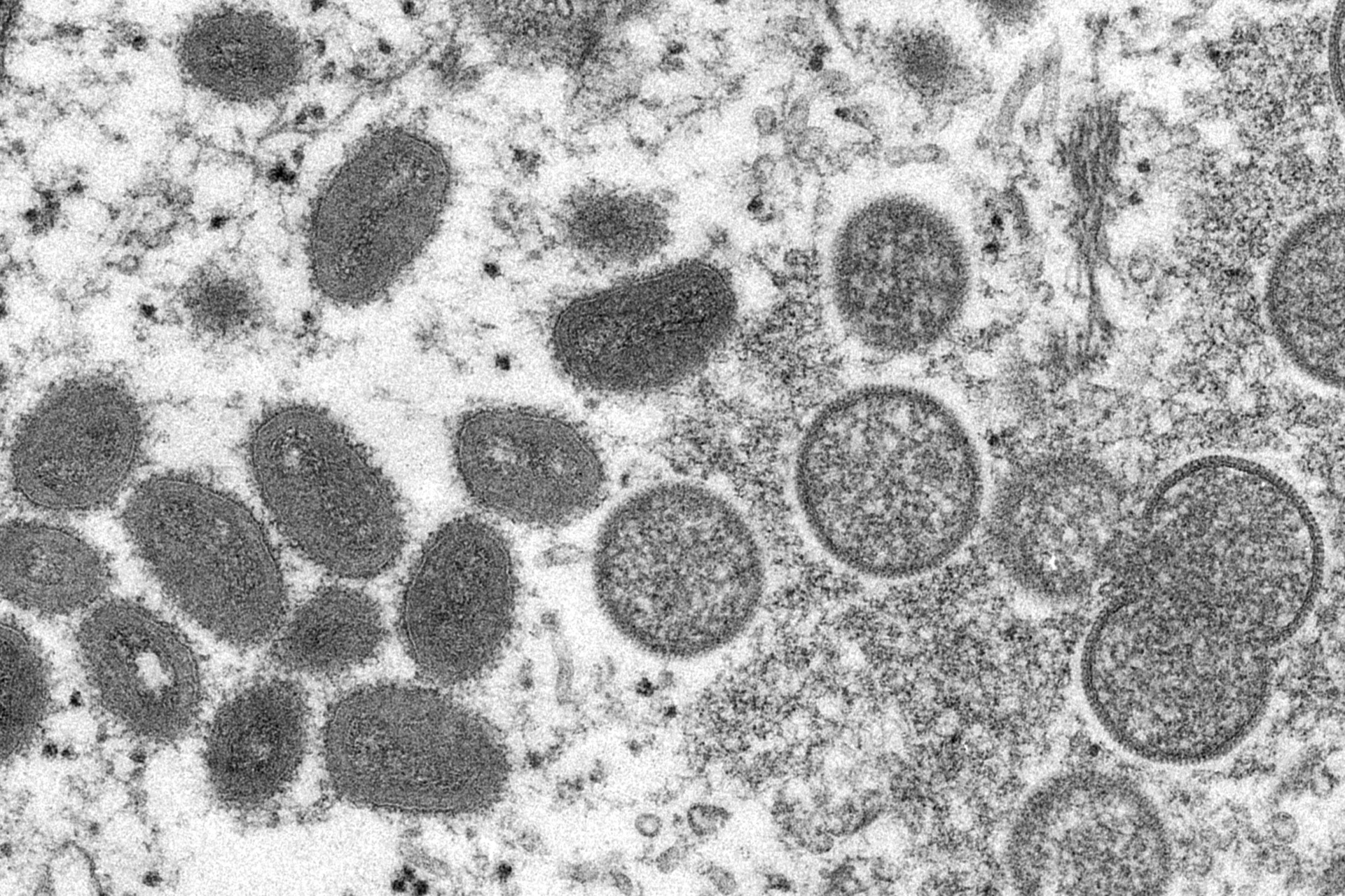 Monkeypox virus could become entrenched as new STD in the US - Vimarsana News