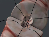 Report: Vasectomies in High Demand Following Roe v. Wade Reversal