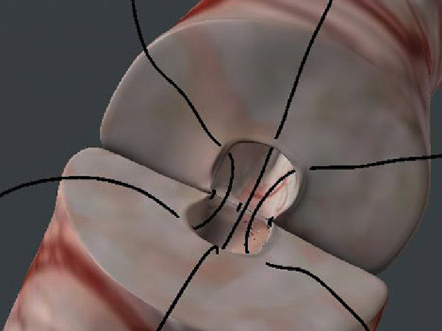 Report: Vasectomies in High Demand Following Roe v. Wade Reversal - Vimarsana News
