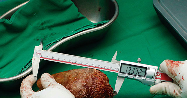 WATCH: Doctors Remove World's Largest Kidney Stone