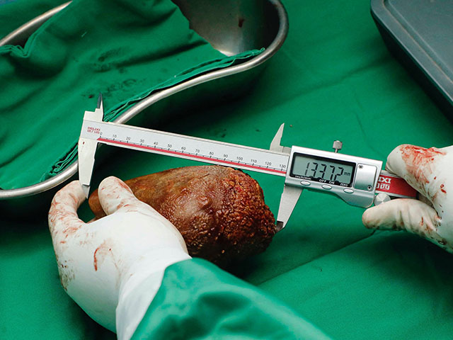 WATCH: Doctors Remove World's Largest Kidney Stone - Vimarsana News