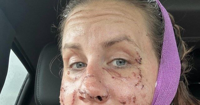 PHOTOS: Montana Woman Survives 'Vicious and Relentless' Otter Attack