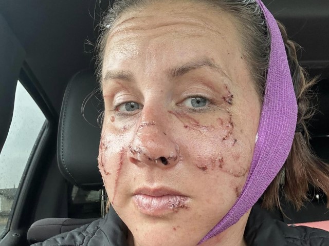 PHOTOS: Montana Woman Survives 'Vicious and Relentless' Otter Attack - Vimarsana News
