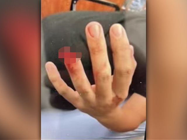 An illegal alien is accused of biting off a piece of a New York City police officer’s finger after his arrest late Wednesday.