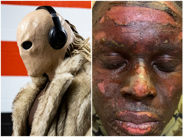 Browns’ David Njoku Played Against Ravens After ‘Bonfire’ Burned His Face and Hands, He Is ‘Another Species’