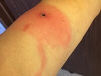 Alaska Health Officials: First Deadly Case of Alaskapox Kills Elderly Man