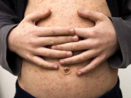 Six Measles Cases Confirmed in Florida School District