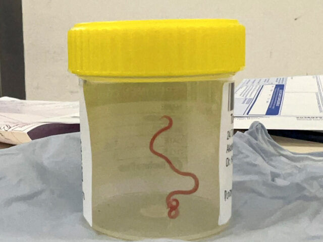 This undated photo supplied by Canberra Health Services, shows a parasite in a specimen ja