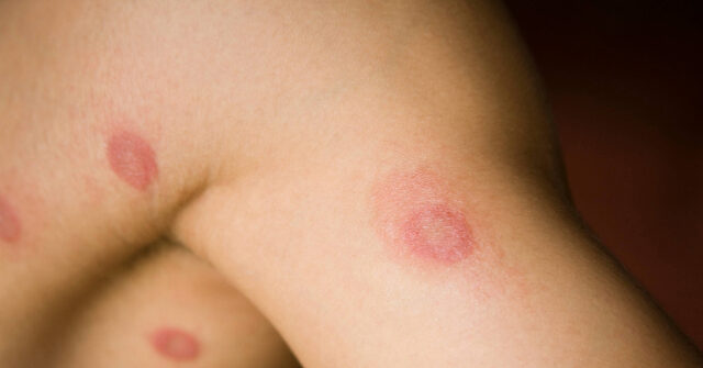 First Case of Sexually Transmitted Ringworm Reported in U.S.