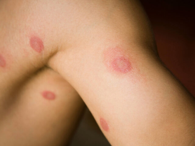 First Case of Sexually Transmitted Ringworm Reported in U.S.