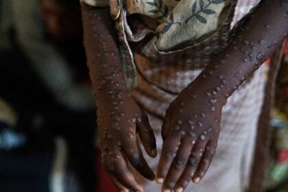 A patient with mpox being treated at the Kavumu hospital, 30 kilometres outside Bukavu in