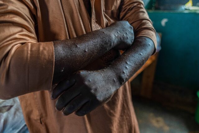 An mpox patient at a health centre in eastern DRC