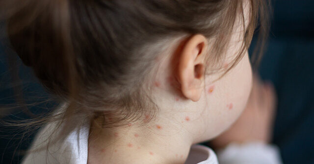 VIDEO: Measles Outbreak Rages in Texas with 48 Cases Identified