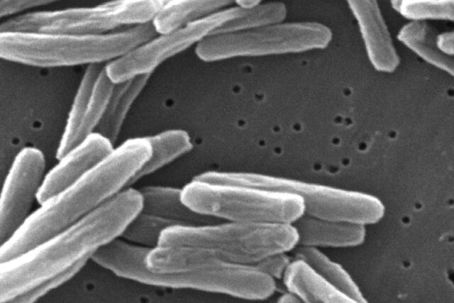 US TB Tuberculosis The Associated Press