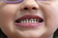FDA and RFK Jr. aim to remove fluoride supplements used to protect kids’ teeth