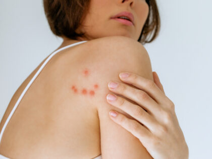 VIDEO: Chicago Named Worst U.S. City for Bedbugs Fifth Year in a Row