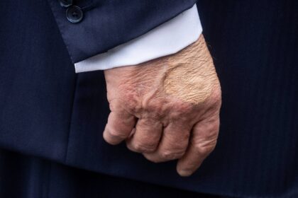 US President Donald Trump's right hand is bruised due to shaking hands and taking asp