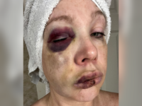 WATCH: Cincinnati Brawl Victim Reveals She Suffered ‘Bad Brain Trauma’