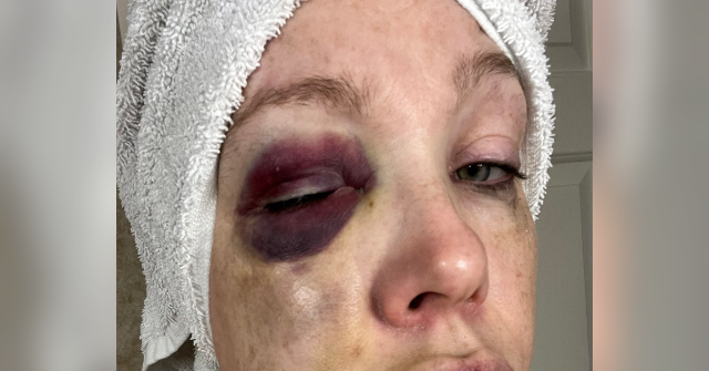 WATCH: Cincinnati Brawl Victim Reveals She Suffered 'Bad Brain Trauma'
