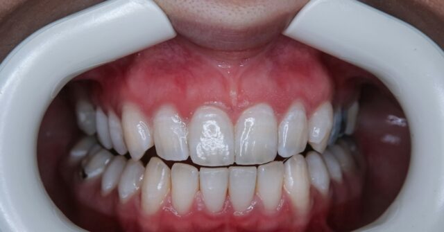 VIDEO -- Police: Florida Woman Posing as Veneer Tech Used 'Crazy Glue' on Clients' Teeth