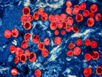 Severe Strain of Monkeypox Virus Detected in Los Angeles