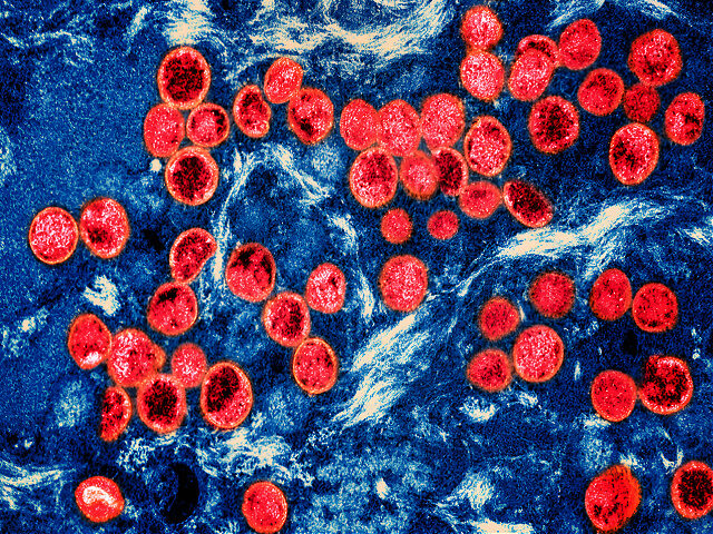 color-micrograph-monkeypox-virus-getty Colorized transmission electron micrograph of monkeypox virus particles (red) found within