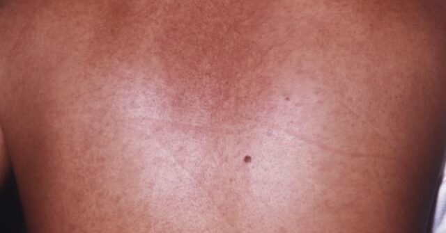 Ethiopia Confirms Outbreak of Lethal Marburg Virus