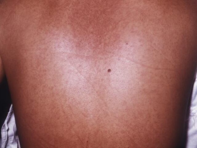 The Africa Centers for Disease Control (Africa CDC) and World Health Organization (W.H.O.)