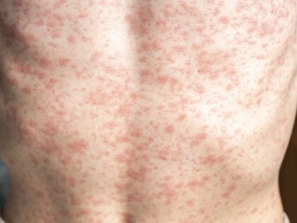 A person's body is covered in a rash, measles.