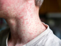 Pennsylvania: Two Die from Measles, First in 35 Years